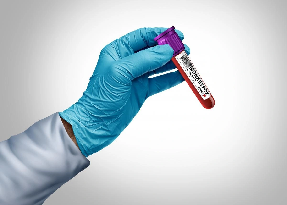 У Європі набирає обертів новий штам mpox: медики попереджають про локальне поширення